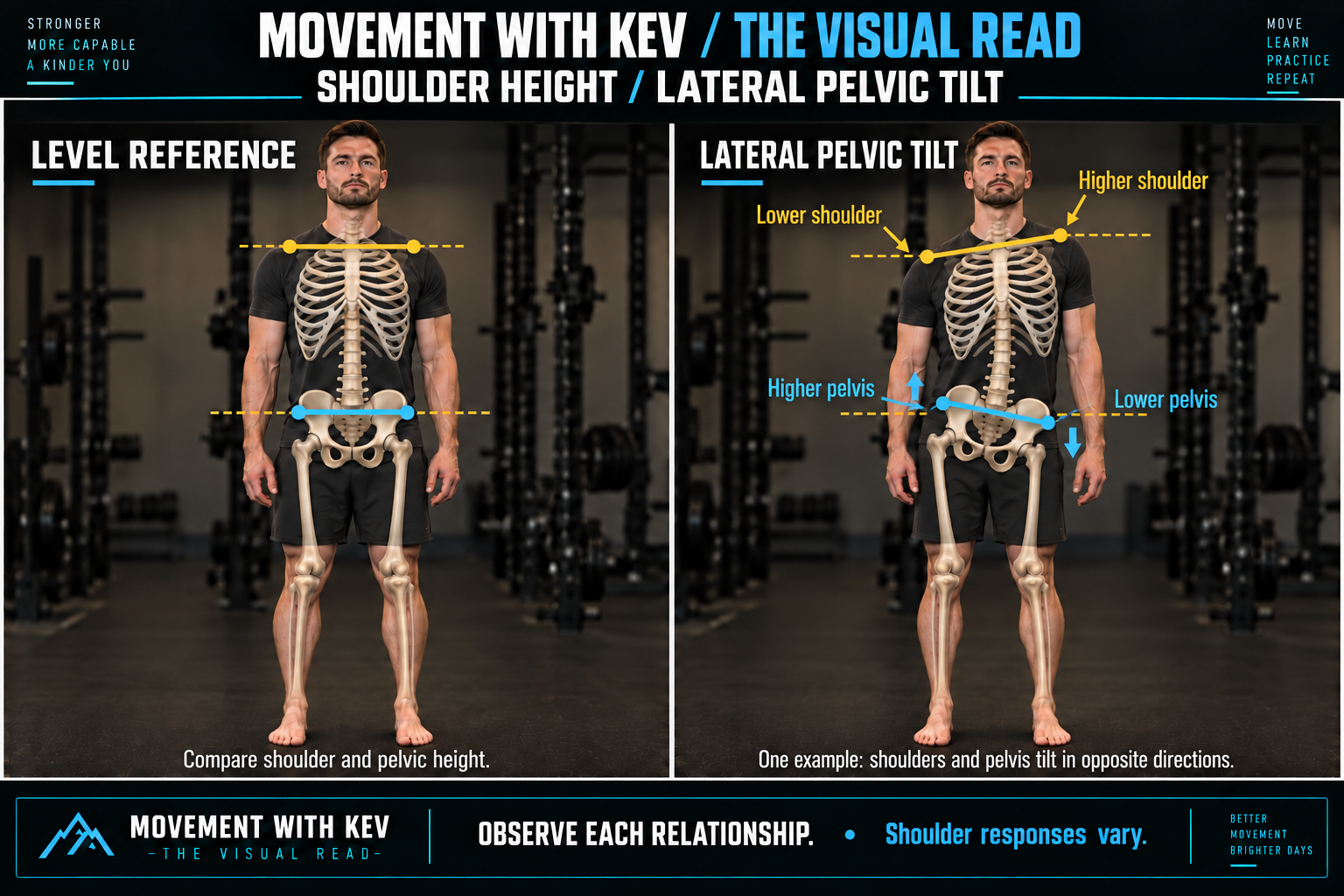 Front-view comparison of level shoulder and pelvic height with an example of lateral pelvic tilt. On the viewer’s left, the pelvis is higher and the shoulder is lower; on the viewer’s right, the pelvis is lower and the shoulder is higher. Gold shoulder markers and blue pelvic markers show the opposing slopes.